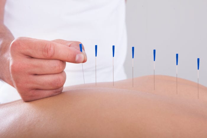 akupunktur lindrer smerte
