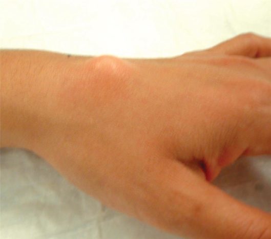 Øvre håndleddspole ganglioncyst (kilde: American Society for Hand surgery)