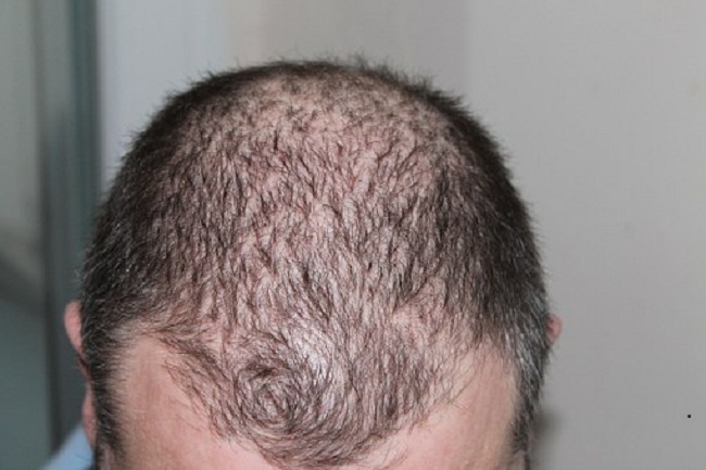 Mennesket skallet hår er ufruktbart