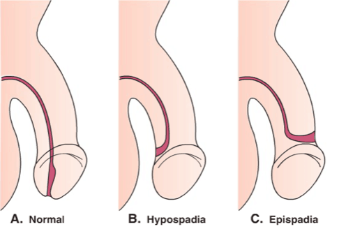 penishullet er ikke normalt, episoder av hypospadier