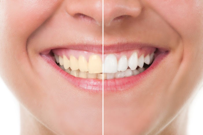 Bivirkninger av tannbleking med bleking