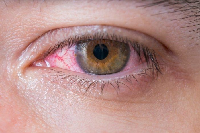 allergisk røde øye konjunktivitt