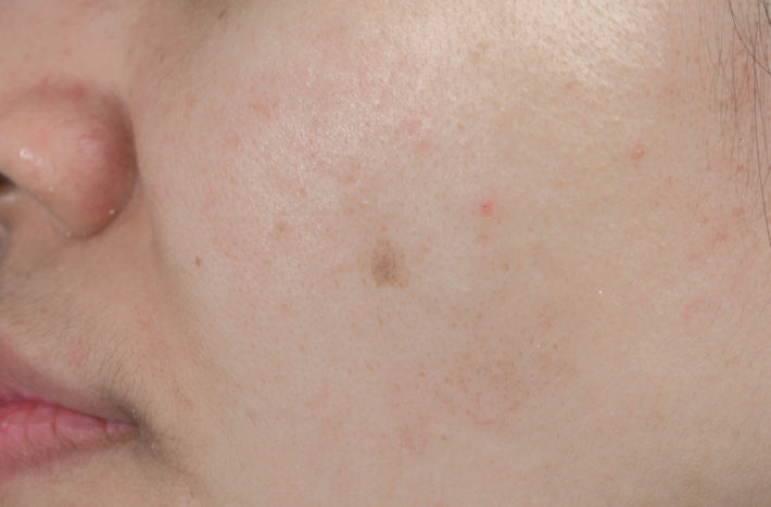 hvordan bli kvitt acne arr svart flekker