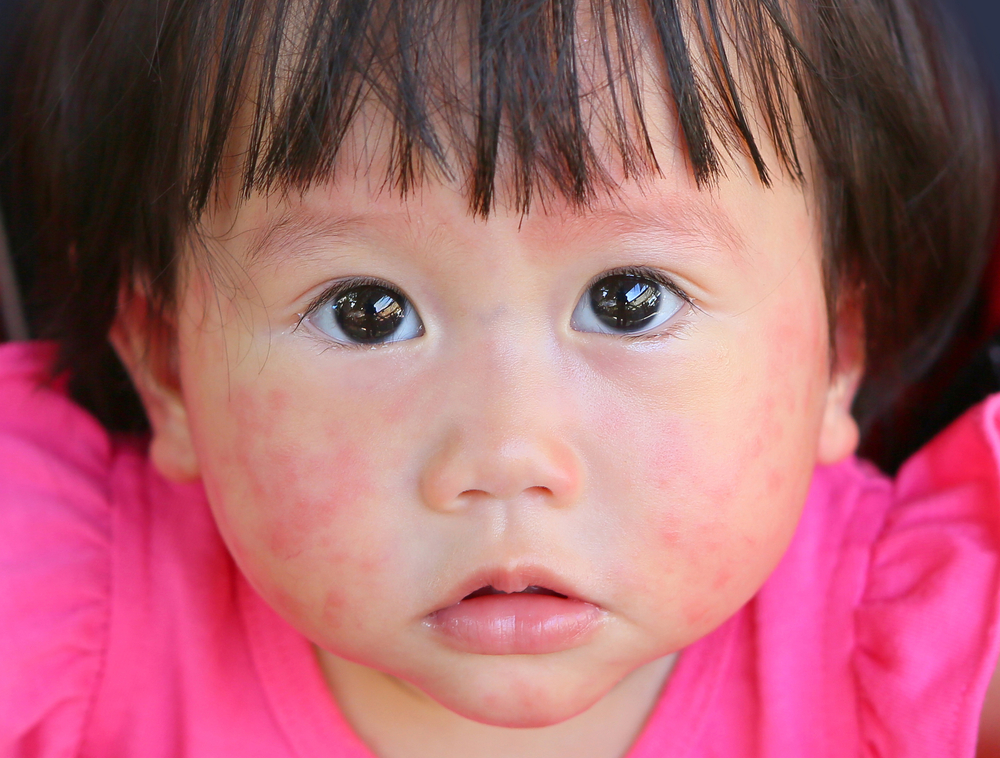 egenskaper hos babyer som er allergiske mot kumelk