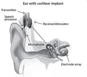 cochlear implantat enhet