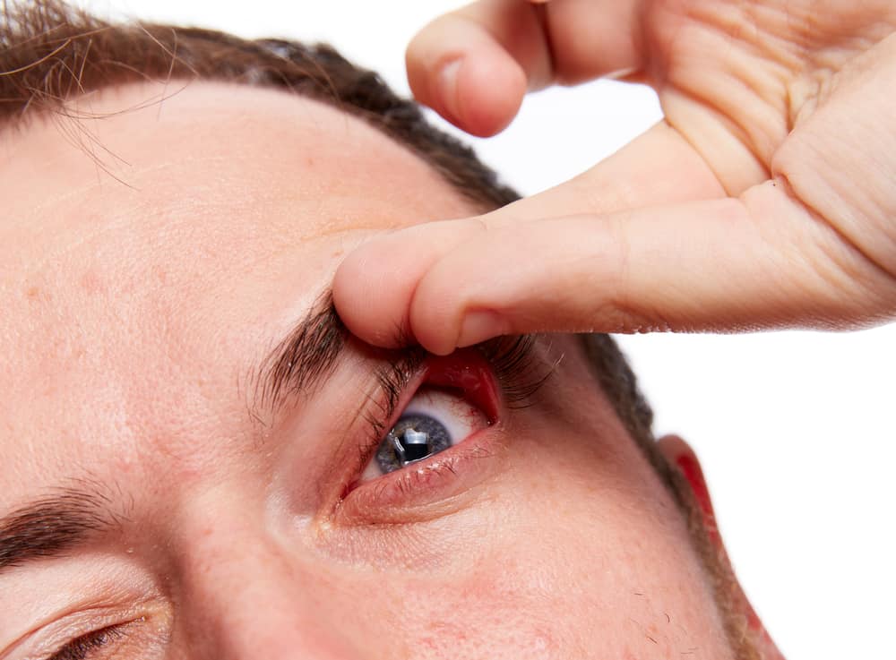 floppy eyelids hengende øyelokk syndrom