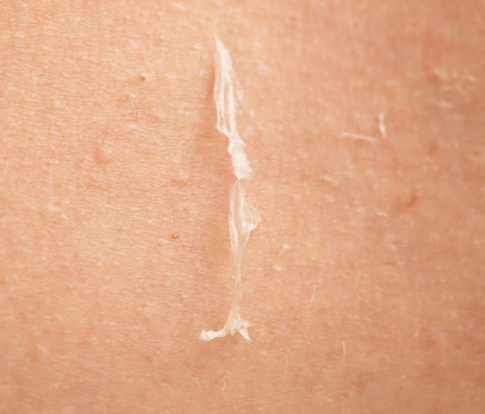 årsaker til å overvinne peeling hud
