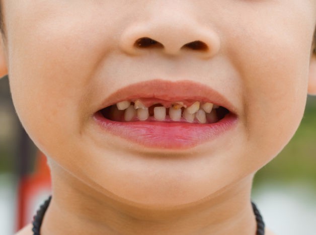 skade på barns tenner