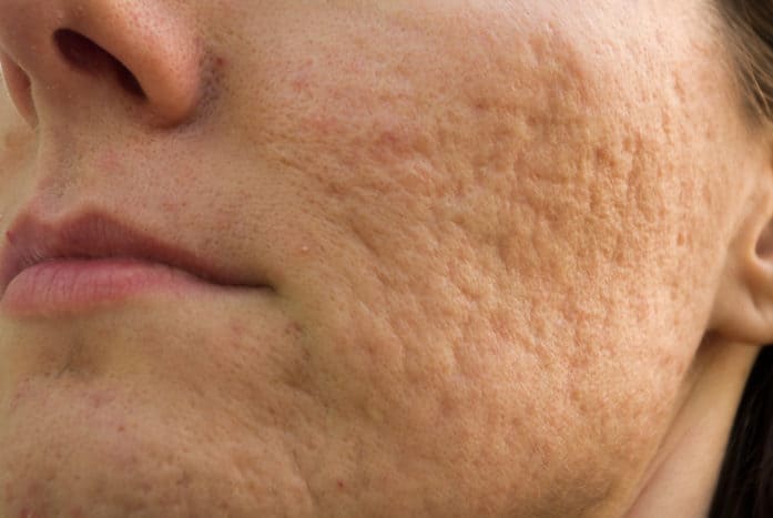 hvordan bli kvitt pockmark acne arr